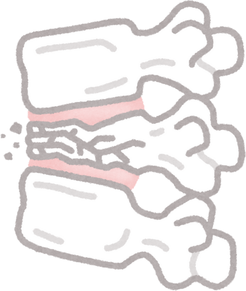 Illustration of Spinal Compression Fracture